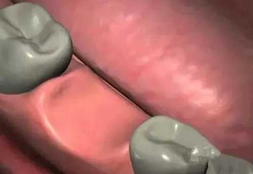 張家口種植牙門診