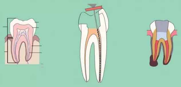 張家口根管治療