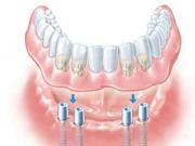 種植牙過程一目了然