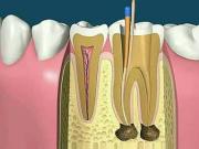 根管治療的規(guī)范步驟