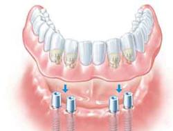 種植牙過程一目了然