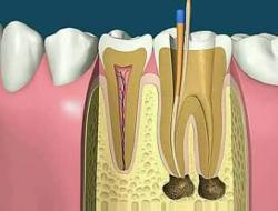 根管治療的規(guī)范步驟