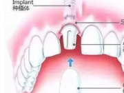 種植牙的過(guò)程