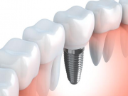 種植牙之先需要注意什么？