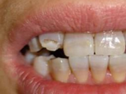 為什么牙齒這么容易壞？