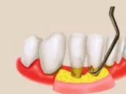 牙齦肉里邊會有結石嗎？