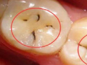 牙齒上小黑點應急早治療