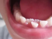 孩子乳恒牙如何正常交替