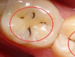 牙齒上小黑點(diǎn)應(yīng)急早治療