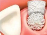 什么情況下需要植骨