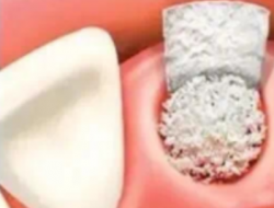 什么情況下需要植骨