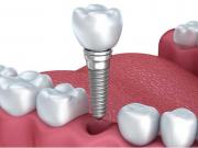 張家口種植牙哪里好？