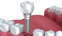 張家口種植牙哪里好？